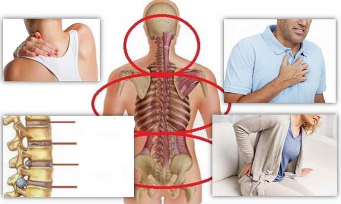 Osteokondroz uchun kasallik joylari