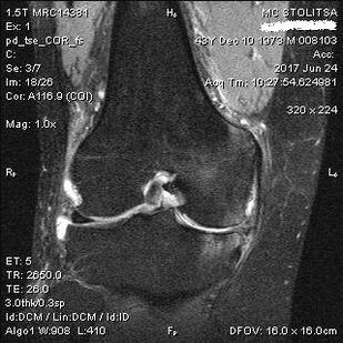Tizzaning tizzasining osteoartrit MRI-da
