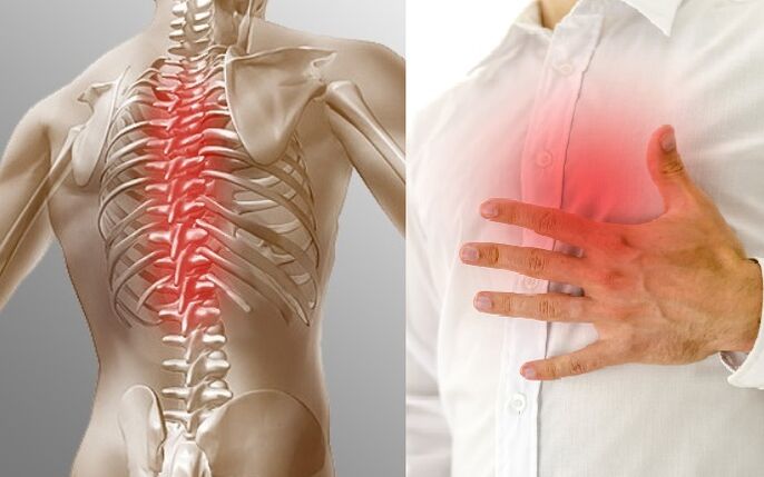 Torakal osteoxondroz og'riq va ko'krak qafasidagi siqilish hissi bilan namoyon bo'ladi